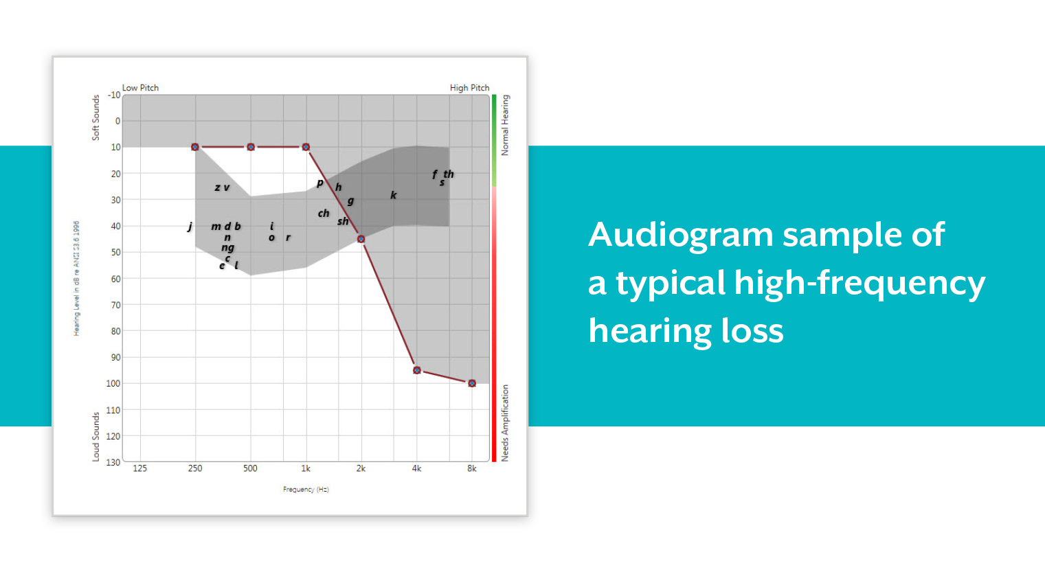 What is high-frequency hearing loss?